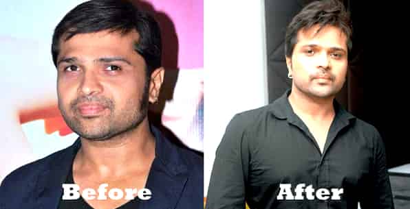 Bollywood Actors Hair Transplant Before and After Images - TrendingWeBlog